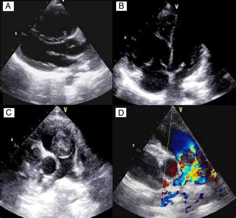 Right Ventricular Myxoma Obstructing The Right Ventricular Outflow