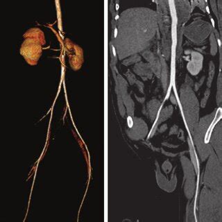 extraperitoneal bladder rupture    year  man   involved