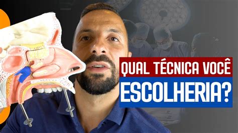 QUAL A MELHOR TÉCNICA PARA CIRURGIA DE ADENOIDE YouTube