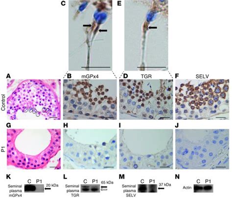 Jci Mutations In The Selenocysteine Insertion Sequencebinding