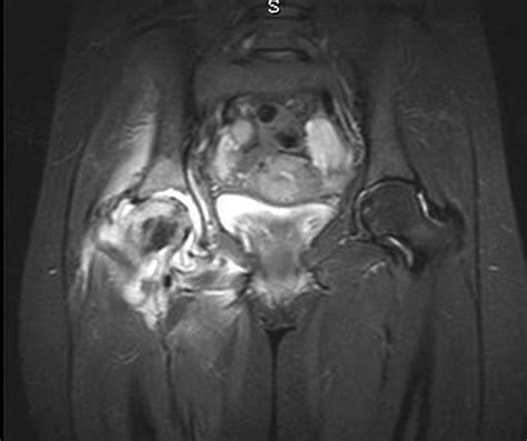 Osteoarthritis Hip Mri