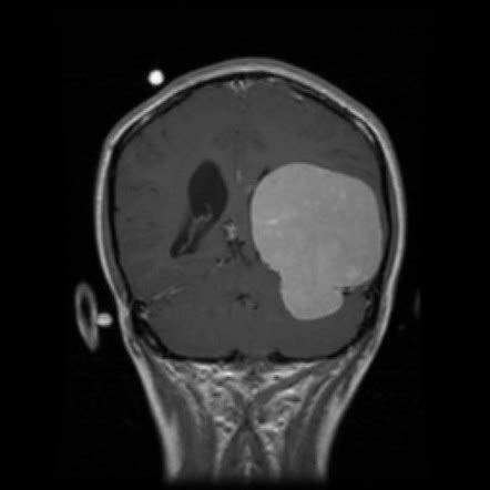 Meningioma Radiology Case Radiopaedia Org