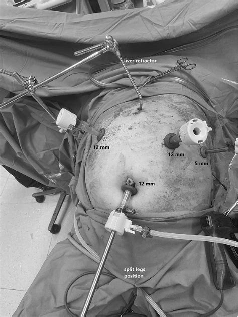 Figure From Impact Of Minimally Invasive Intrathoracic Hand Sewn