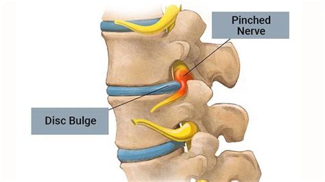 Bulging Disk 10 Tips For Relief Entirely Health