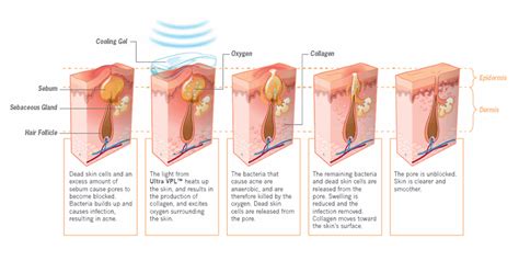 Acne Bacteria: Acne Bacteria: Does It Really Cause Acne?