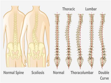 Adolescent Idiopathic Scoliosis Surgery In India