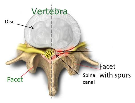 4 Exercises For Lumbar Facet Irritation: Lumbar Facet Syndrome · Bodi ...