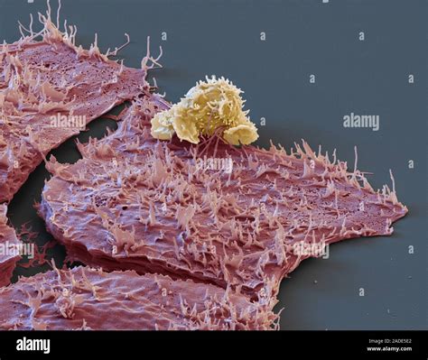 White Blood Cells Attacking Cancer Cells Coloured Scanning Electron