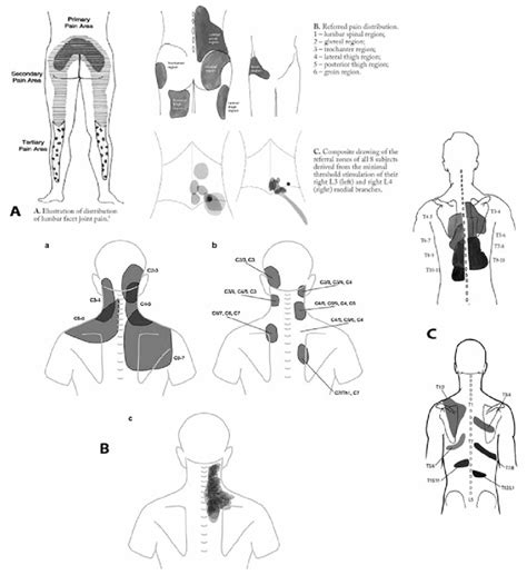 A. Patterns of lumbar facet joint pain based on descriptions of ...