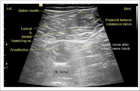 Posterior Femoral Cutaneous Nerve Block