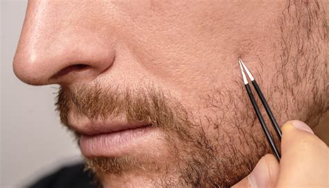 5 Tips To Reduce Ingrown Hair In Beards