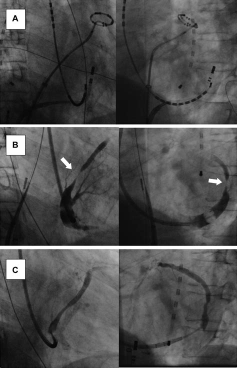 Coronary Sinus Stenosis As Collateral Damage Of Radiofrequency Ablation