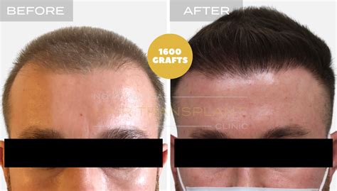 Hair Transplant Clinic Nyc Fue Hair Transplantation Experts