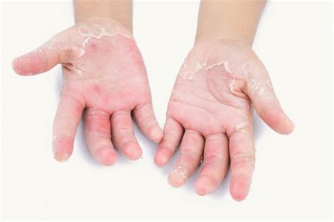 Treating Palmar/Plantar Psoriasis | The Dermatology Center Of Indiana