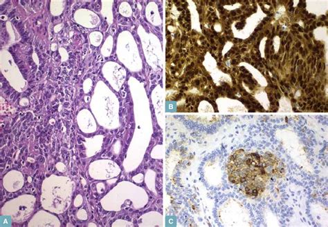 Cribriform-morular thyroid carcinoma showing a predominant cribriform ...