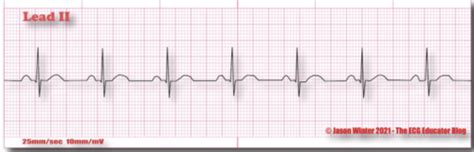 Ekgs Flashcards Quizlet