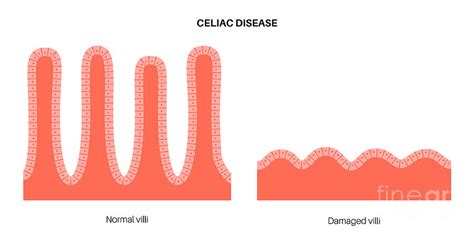 Villi Small Intestine Celiac Disease