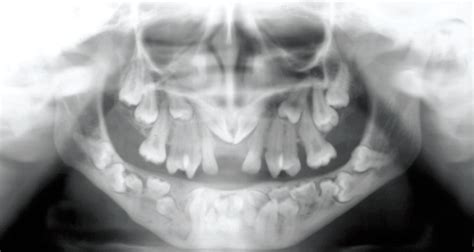 Panoramic Radiograph Is Showing That Multiple Impacted Open I