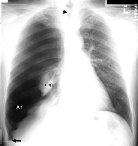 Pneumothorax Vs Atelectasis