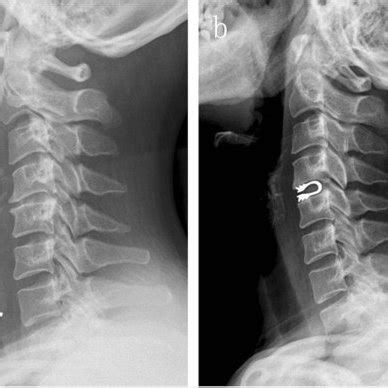 Pdf Comparisons Of Three Anterior Cervical Surgeries In Treating