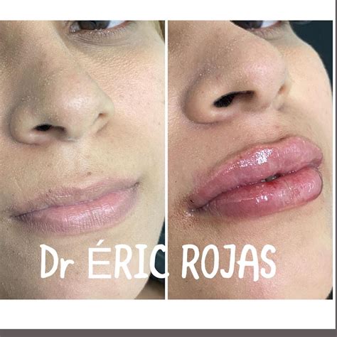 Modelado Labial Dr Eric Rojas Dermatolog A Laser Center