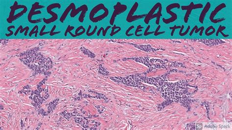 Desmoplastic Small Round Cell Tumor 5 Minute Pathology Pearls Youtube