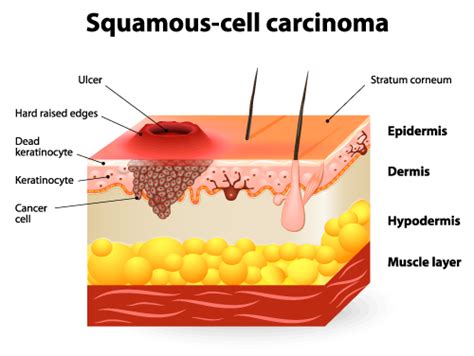 Squamous Cell Brownstone Dermatology