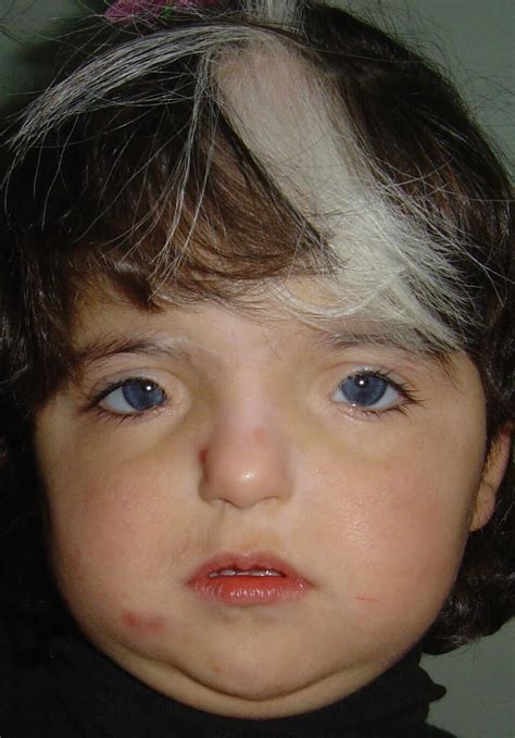 Waardenburg Syndrome - Symptoms ,Pictures ,Causes And Treatment