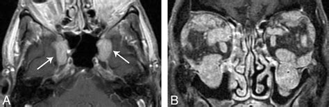 immunoglobulin  related disease   orbit imaging features