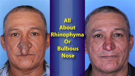 New York Man Treated For Rhinophyma Or Bulbous Nose: Causes, Symptoms ...