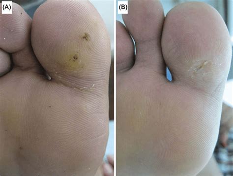 A Plantar Warts Before Treatment B Complete Resolution After