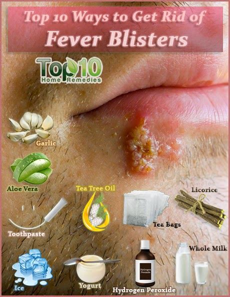 How To Get Rid Of Fever Blisters ~ Mzizi Mkavu