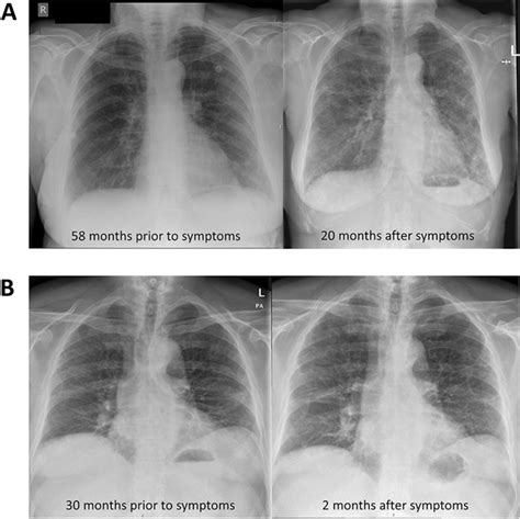 Examples of patients who had potential interstitial lung abnormalities ...