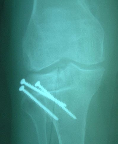 The Knee Diaries: rejection of Osteochondral Allograft - Arthritis USA ...