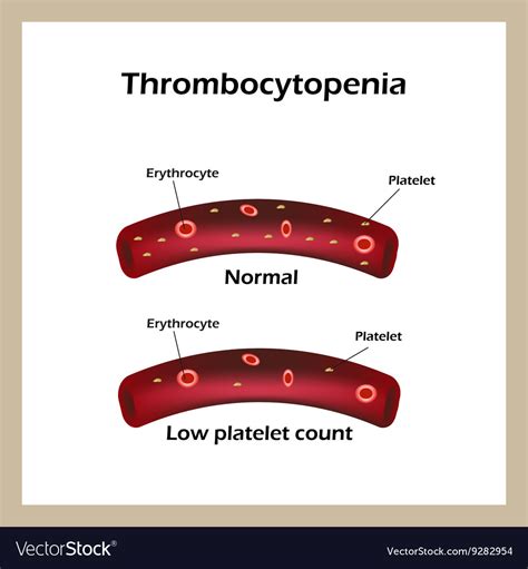 Thrombocytopenia reduced levels of thrombocytes Vector Image