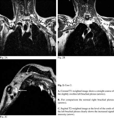 Figure From Radiation Induced Brachial Plexopathy Chapter