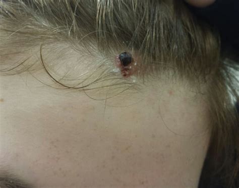 Early Squamous Cell Carcinoma Scalp