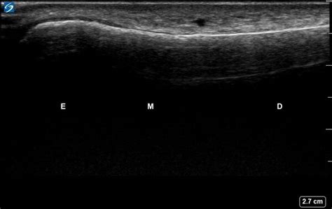 Pediatric Distal Forearm Fractures Ultrasound Diagnosis Of Pediatric