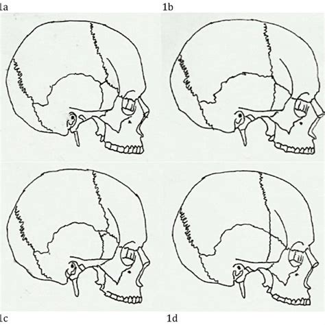 Showing distances of pterion to some special landmarks. P: Pterion,... | Download Scientific Diagram