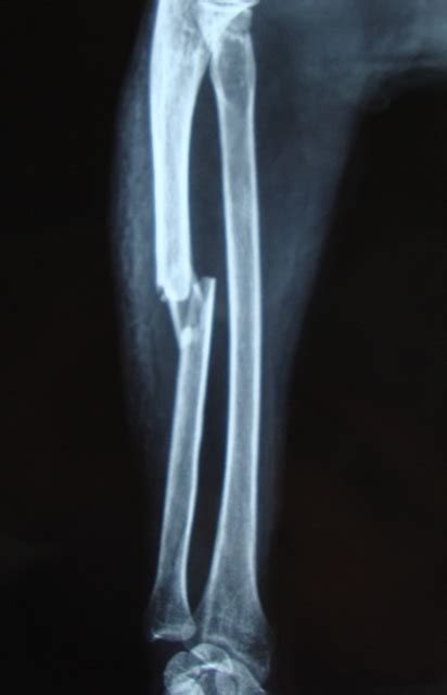 Left Distal Ulna Fracture