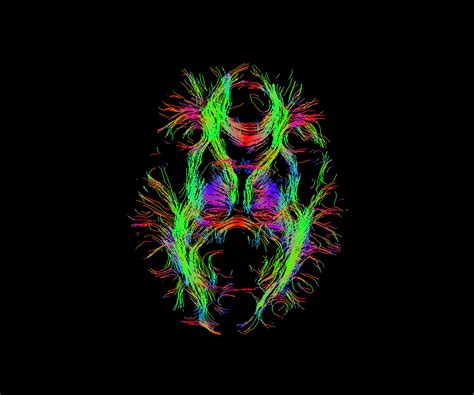 whole_brain_tractography_dti_DTI_KHURANA | C.N.S. Neurosurgery