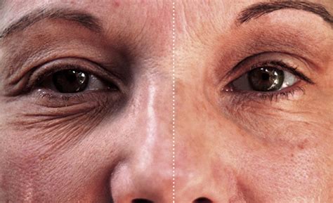 Facial Toning Exercises Facial Before And After Facial Devices Anti