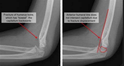 MSK Elbow And Forearm Injuries Flashcards Quizlet