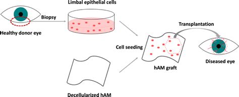 Transplantation Process Of Autologous Limbal Epithelial Cells