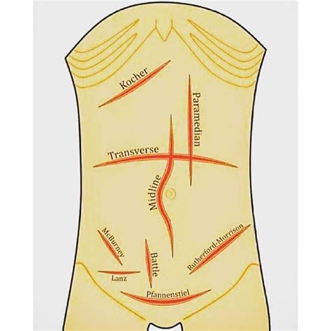 Mosaiced On Instagram Types Of Abdominal Incisions Medstudent