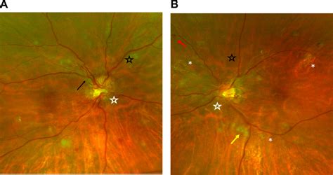 Figure From A Review Of Hypertensive Retinopathy And