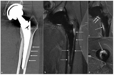 Imaging In Hip Arthroplasty Management Part Postoperative Diagnostic