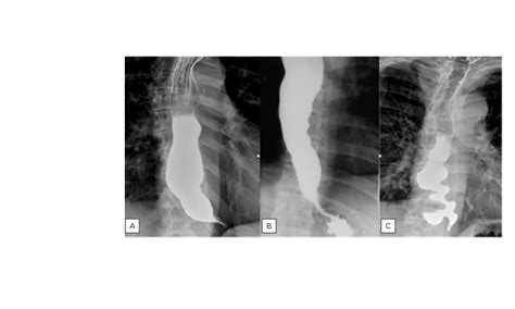 Achalasia