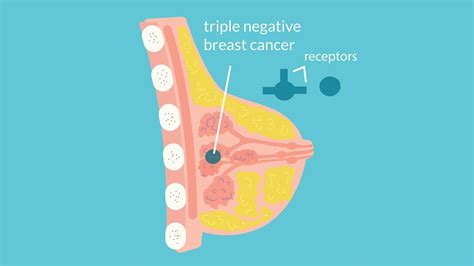 Triple negative breast cancer prognosis - taxireka