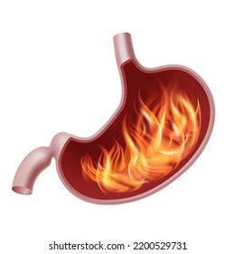 Burning Stomach Realistic Human Organ Internal Stock Vector Royalty